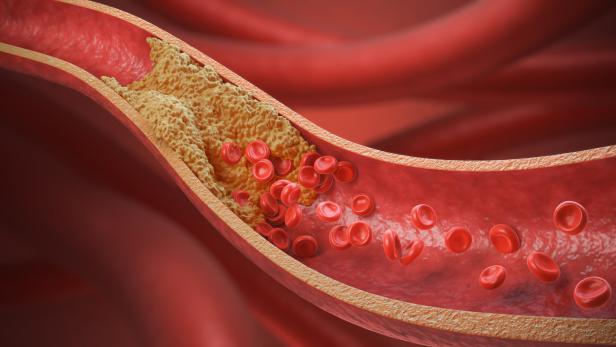 Das Bild zeigt eine grafische Darstellung einer Arterie, die durch Plaques fast verschlossen ist.